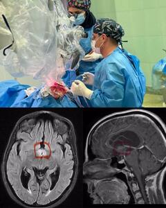 نخستین عمل جراحی تومور مغز در ایلام