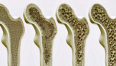 نشانه‌های پوکی استخوان را جدی بگیرید! - سبک ایده آل