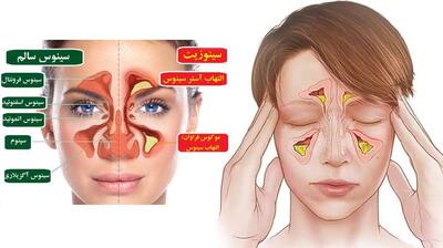 میگنا - «سینوزیت» و «سرماخوردگی» چه فرقی با هم دارند؟