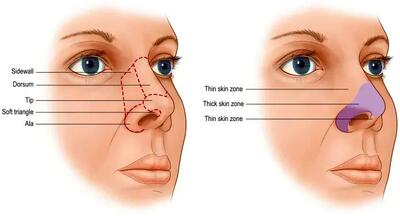 عمل بینی غضروفی با پوست نازک چیست