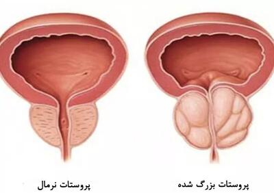 بدون دارو از بزرگ شدن پروستات پیشگیری کنید