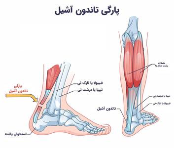 جراحی تاندون آشیل با پرده جفت جنین