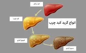 کبد چرب چند گرید دارد؟ آشنایی با انواع و علائم هر مرحله