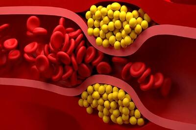 چگونه کلسترول بد خون را کاهش دهیم؟