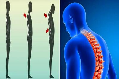 متخصص ترین پزشک ها برای درمان قوز کمر در کرج / درمانی در سطح بین المللی