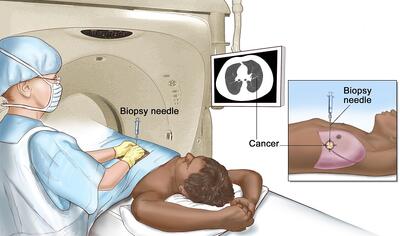 آنچه باید درباره نمونه برداری یا بیوپسی ریه بدانید