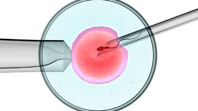 iui چیست؟ + جزئیات شانس بارداری