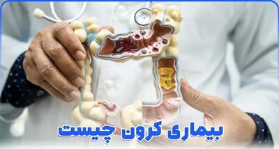 بیماری کرون چه علائمی دارد؟ + راه های درمان و تشخیص در زنان و مردان