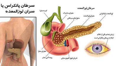 میگنا - واکسنی امیدبخش برای سرطان پانکراس