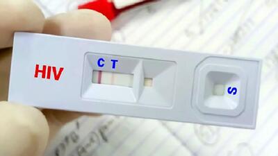 درمان رایگان ایدز؛ کنترل ویروس HIV با دسترسی به خدمات درمانی