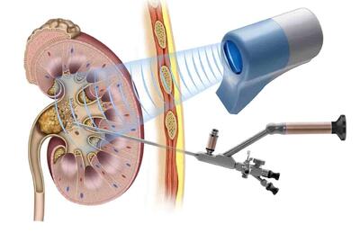 انواع روش ‌های دفع سنگ کلیه