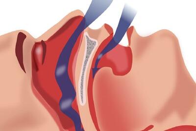 آپنه خواب خطر ابتلا به پارکینسون را افزایش می‌دهد اما چاره دارد
