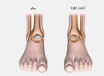 زنگ خطر در هر قدم: چرا مچ پای شما در حین راه رفتن درد می‌گیرد؟