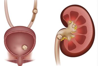 سنگ کلیه خود را درمان کنید