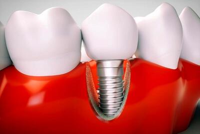 کدام برند ایمپلنت دندان بهتر است؟ مقایسه تخصصی برترین گزینه‌ها