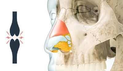 درمان مفاصل آسیب‌دیده زانو با کمک غضروف بینی
