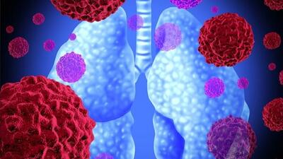 درمان آسیب‌های ریوی با ترکیب نانوذرات لیپیدی و mRNA