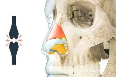 درمان مفاصل آسیب‌دیده زانو با کمک غضروف بینی
