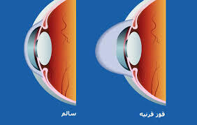 فرق قوز قرنیه با آستیگمات چیست؟