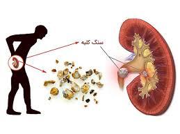 سنگ کلیه؛ طاقت فرساترین درد دنیا