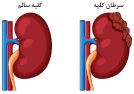 علائم اصلی تومور کلیه چیست؟