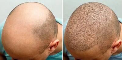 چرا نتیجه کاشت برای همه مو راضی کننده نیست