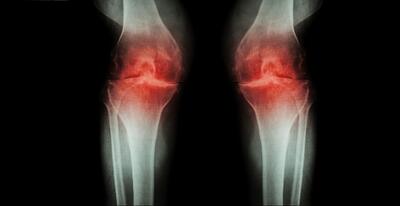 چاقی شایع‌ترین دلیل ابتلا به آرتروز