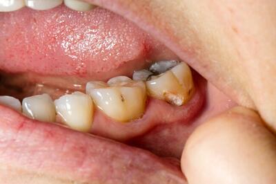 استرس و اضطراب دلیل اصلی مبتلا شدن به این بیماری های دهان و دندان