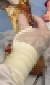 فیلم توده فیبری ۷۰ گرمی در معده زن روس