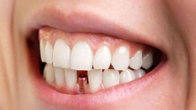 ایمپلنت دندان: نکات کلیدی و بایدها و نبایدها