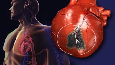 آیا سکته قلبی خفیف بی‌خطر است؟