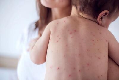 زنگ خطر به صدا درآمد ؛ آمار ابتلا به سرخک صعودی شد