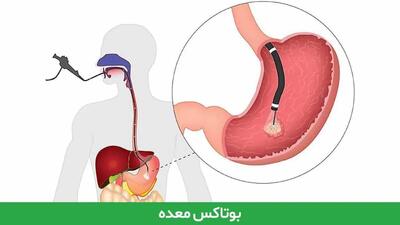 بوتاکس برای کاهش وزن روش مناسبی است؟