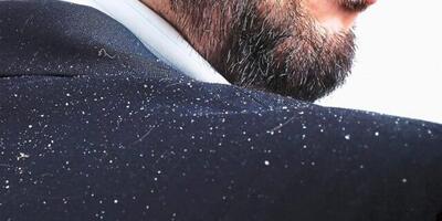 با این روش با شوره موهات خداحافظی کن+فیلم - سبک ایده آل