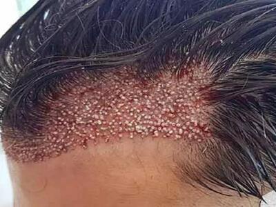 قبل از کاشت مو به این نکات دقت کنید