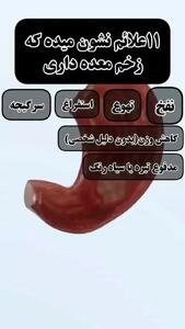 علائم زخم معده + فیلم