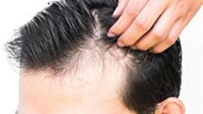بهترین مواد غذایی برای توقف کامل ریزش مو