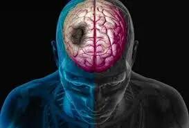 سکته مغزی چه دلایلی دارد؟ زمان طلایی  و اهمیت انتقال فوری بیمار به بیمارستان