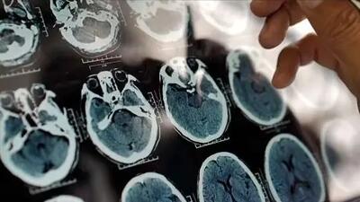 آلزایمر از ۴۰ سالگی در کمین است؛ روش‌های پیشگیری و عوامل مؤثر