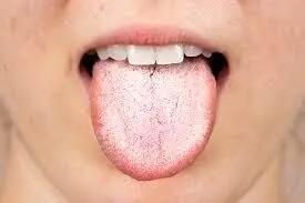 رنگ زبان سفید نشانه چیست؟