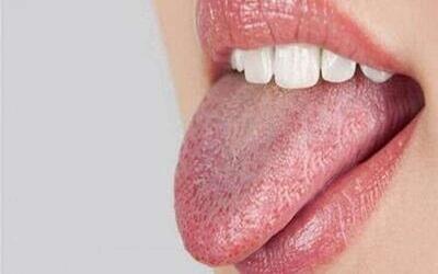 دلایل رایج سفید شدن زبان | شفقنا