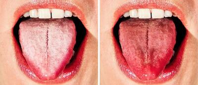 زبان سفید چه چیزی درباره سلامت می‌گوید؟