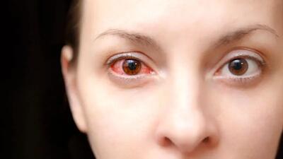 چگونه از چشم ها هنگام موج انفجار مراقبت کنیم؟