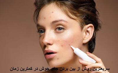 سریعترین روش از بین بردن جای جوش در کمترین زمان با درمان خانگی
