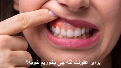برای عفونت لثه چی بخوریم خوبه؟ بهترین آنتی بیوتیک برای عفونت لثه چیست؟