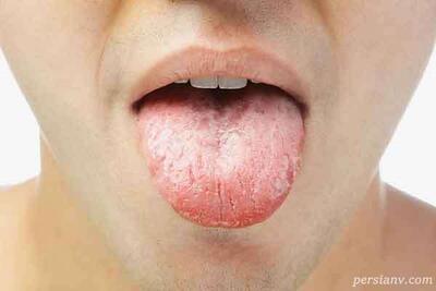 علت ترک خوردن زبان ؛ آیا ترک زبان نشانه بیماری خاصی است؟