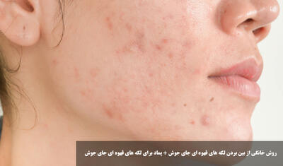 روش خانگی از بین بردن لکه های قهوه ای جای جوش + پماد برای لکه های قهوه ای جای جوش