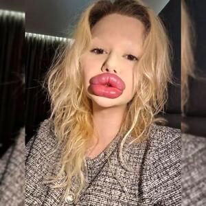هیچ پزشکی حاضر به سرویس‌دهی به صاحب بزرگ‌ترین لب‌های دنیا نیست!