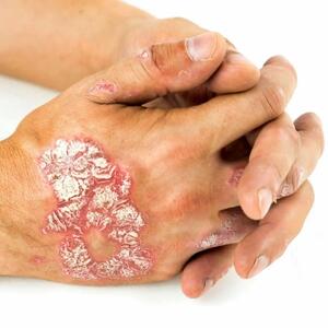 چه چیزی پسوریازیس را تشدید می کند؟
