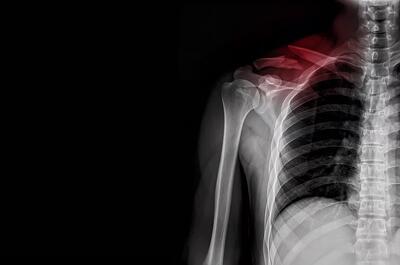 افزایش بستری کودکان به‌دلیل شکستگی ترقوه